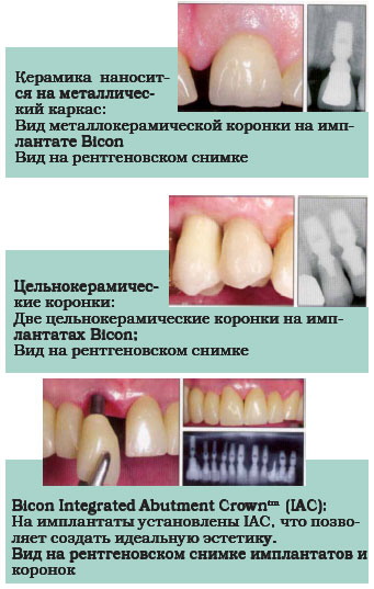Несъемные протезы