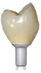 Integrated Abutment Crown