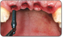 1. Insert a green 3.0mm titanium impression post into the implant well, using finger pressure.