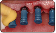 5. Inject impression material around plastic impression sleeves and make impression.