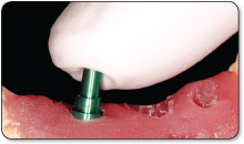 3.0mm impression post