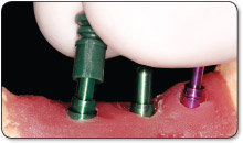 3.0mm plastic impression sleeve