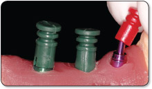 2.0mm plastic impression sleeve